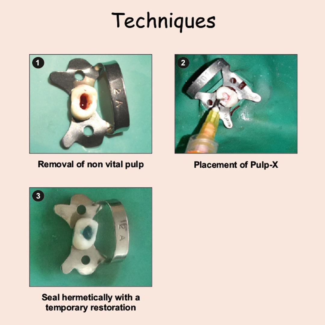 Prevest Pulp X Pulp Devitalizer